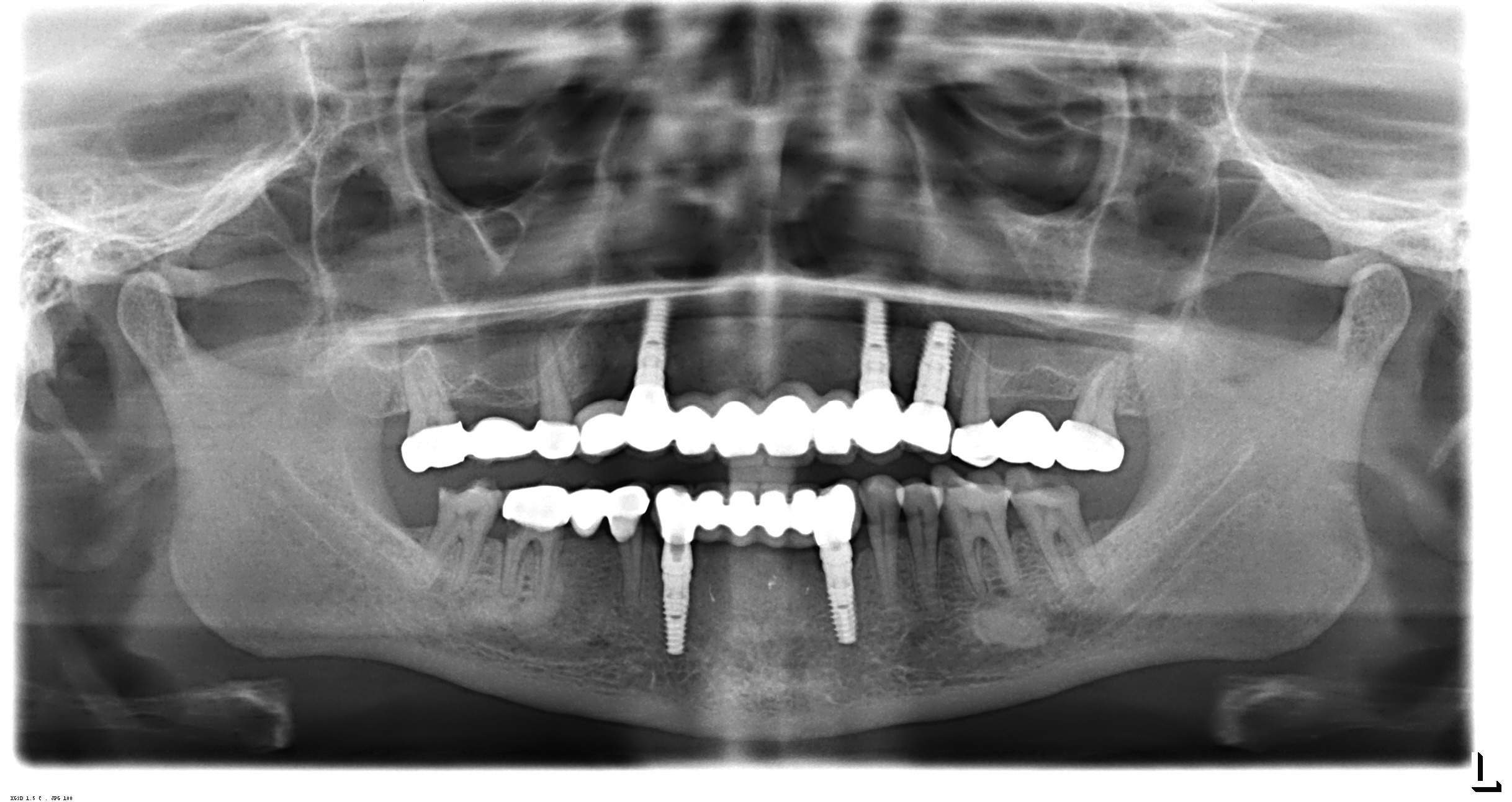 Dental Implants Treatment in Mumbai